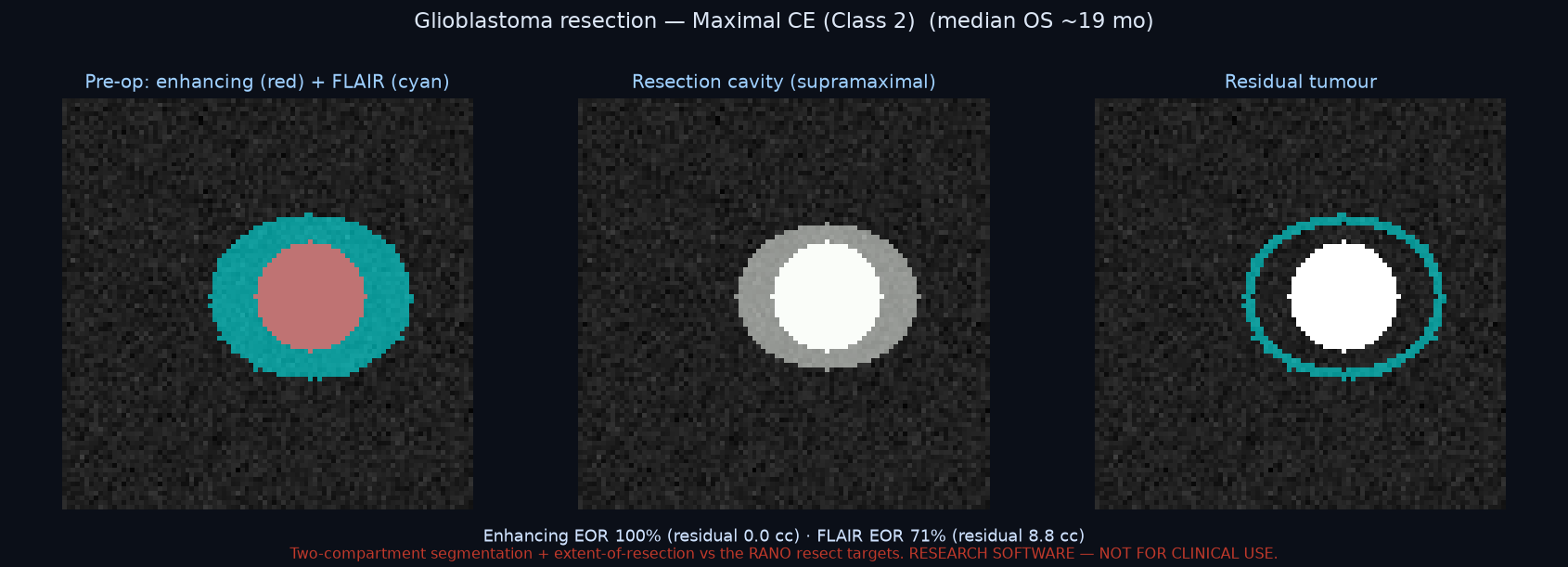 Glioblastoma resection — extent of resection