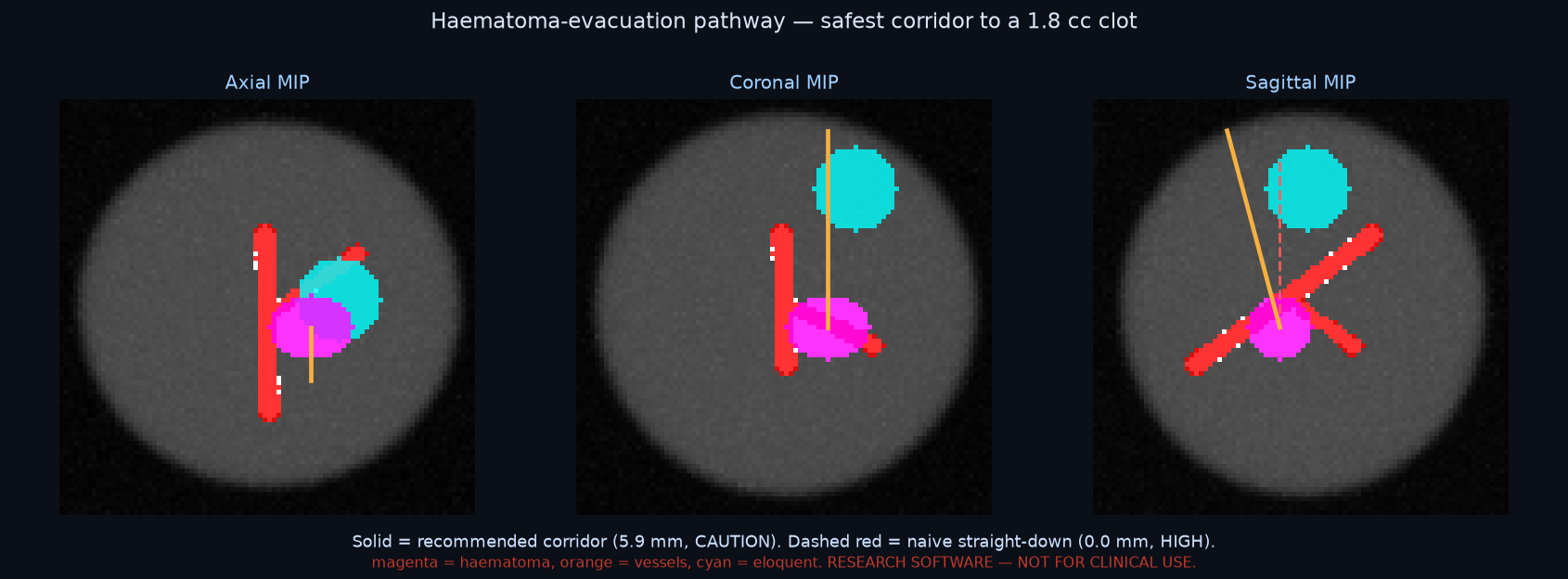 Haematoma-evacuation pathway